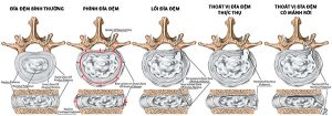 Quá trình thoát vị đĩa đệm