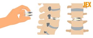 Phẫu thuật thoát vị đĩa đệm